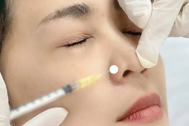 Cân nhắc khi chọn filler