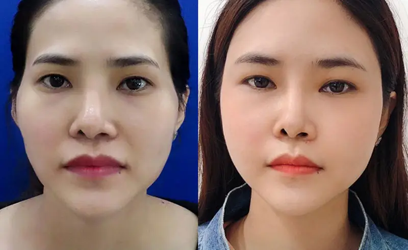 So sánh: Tiêm filler thái dương đau hơn hay dễ chịu hơn so với cấy mỡ hoặc phẫu thuật?