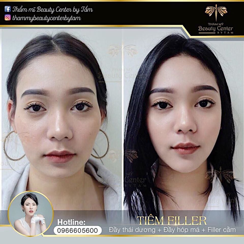 Ai không phù hợp tiêm filler thái dương? Những thuốc và bệnh lý cần lưu ý trước khi tiêm