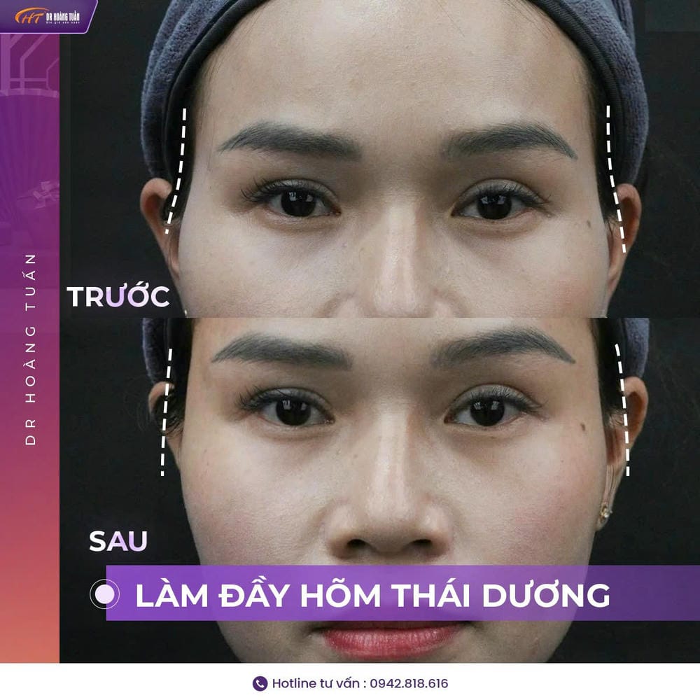 Muốn tiêm filler thái dương: checklist ngắn trước khi đến phòng khám