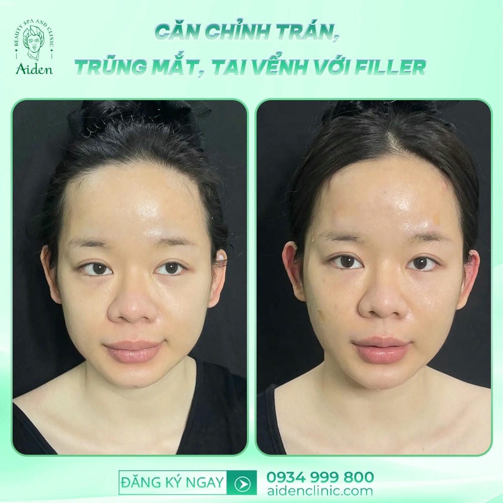 Chi phí tiêm filler trán bao nhiêu, gồm những gì?