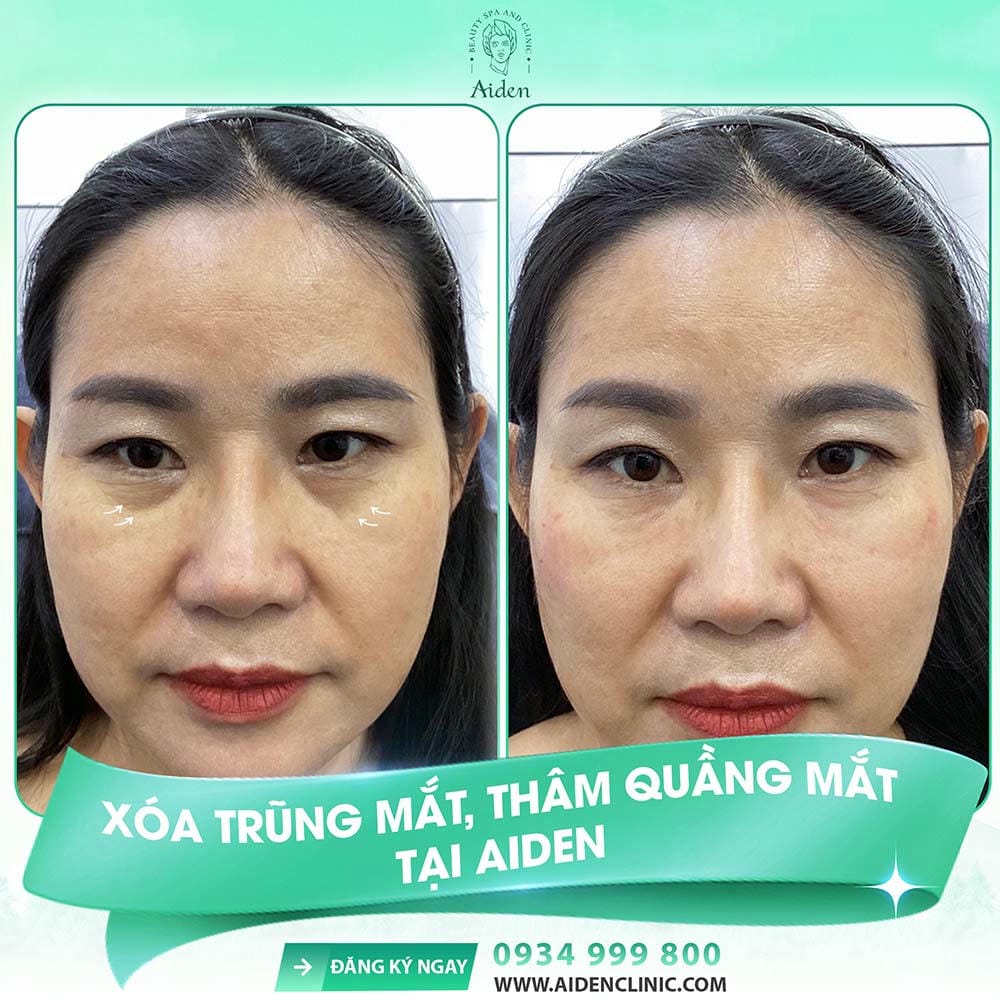 Lưu ý chăm sóc sau tiêm — nên làm và không nên làm?