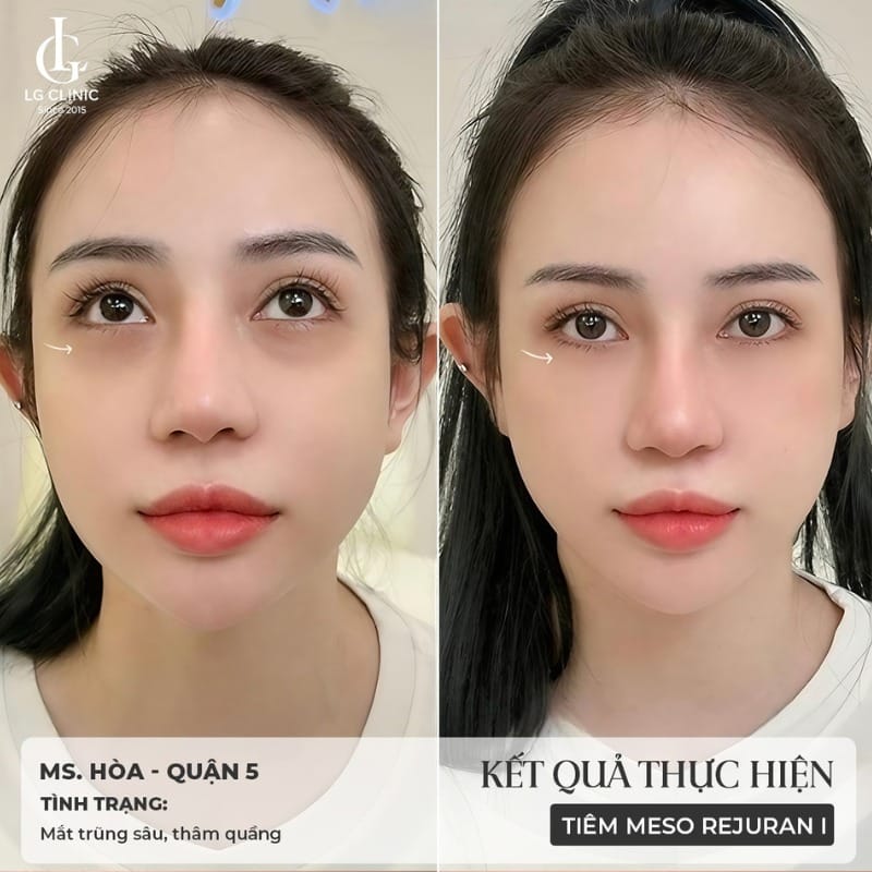 Quy trình, chăm sóc sau và xử trí biến chứng filler mắt