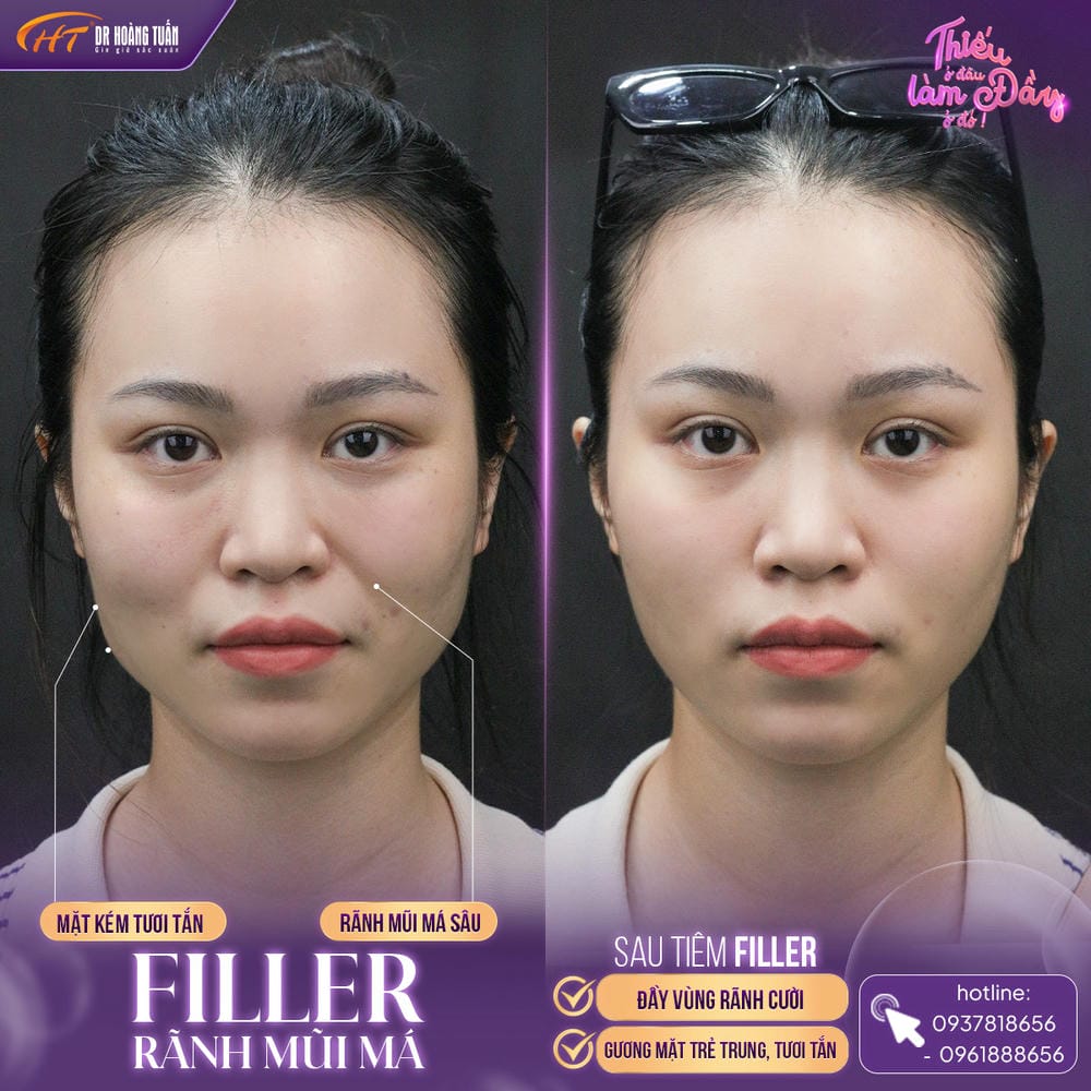 Tiêm filler có an toàn không — biến chứng tiêm filler nào đáng lo nhất?