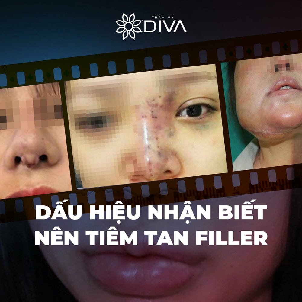 Filler nào phù hợp cho vùng nào?