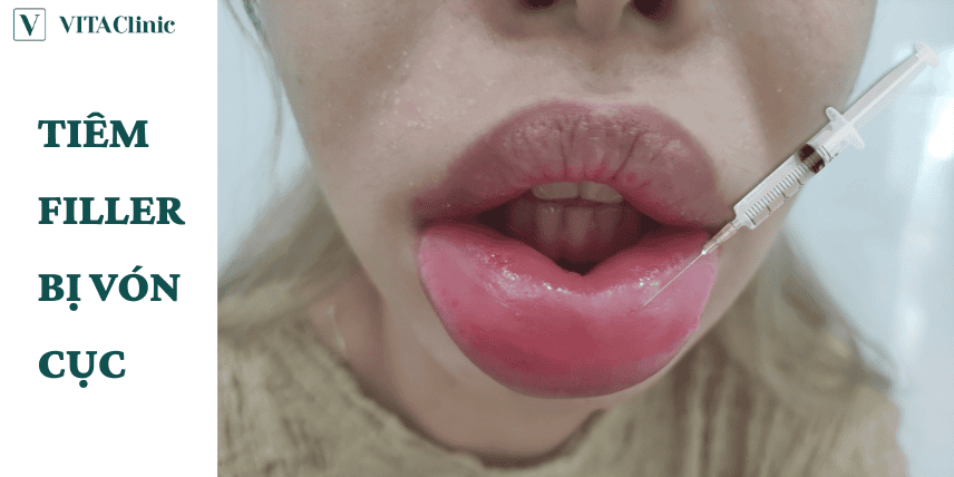 FAQ về tiêm filler: lợi hại, an toàn và chi phí