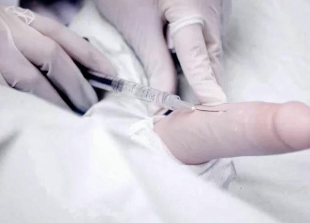 Tiêm filler vào dương vật có an toàn không?