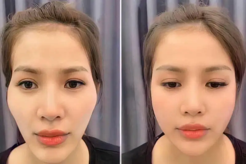 Cannula hay kim — chọn thế nào?