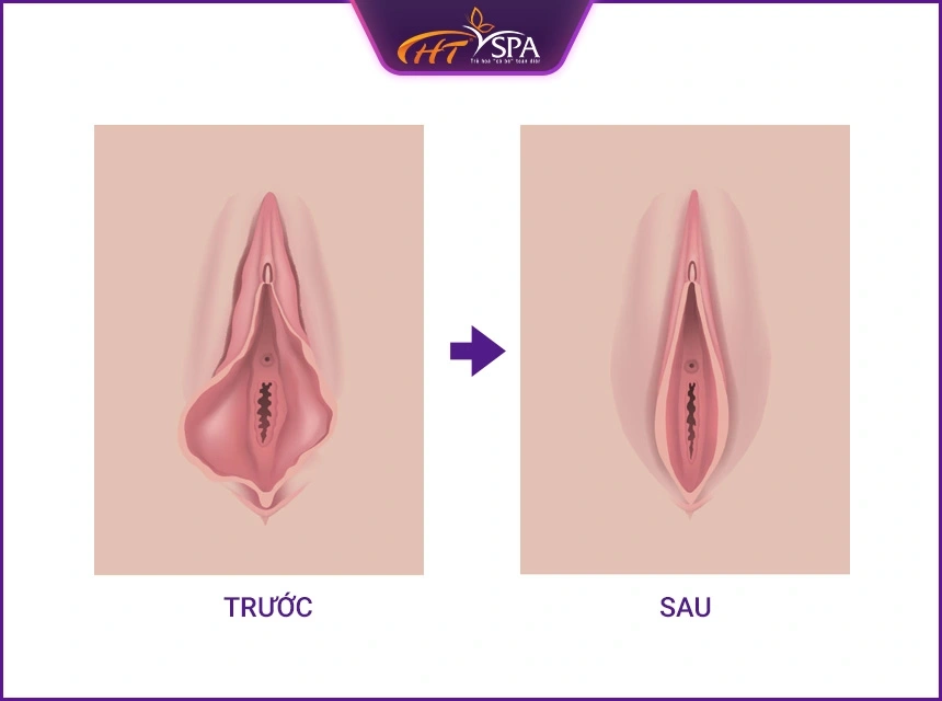 Loại filler phù hợp — HA, PLLA, PCL, CaHA