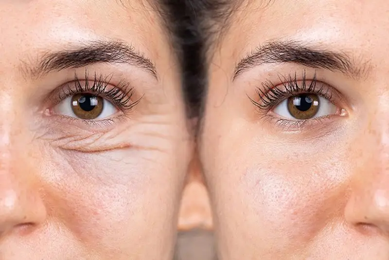 Tiêm filler xóa nhăn mí mắt hoạt động thế nào — nên chọn filler HA vùng dưới mắt nào?