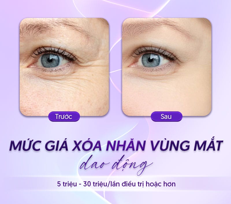 Tiêm filler vùng mí mắt có rủi ro gì — khi nào cần cảnh báo?