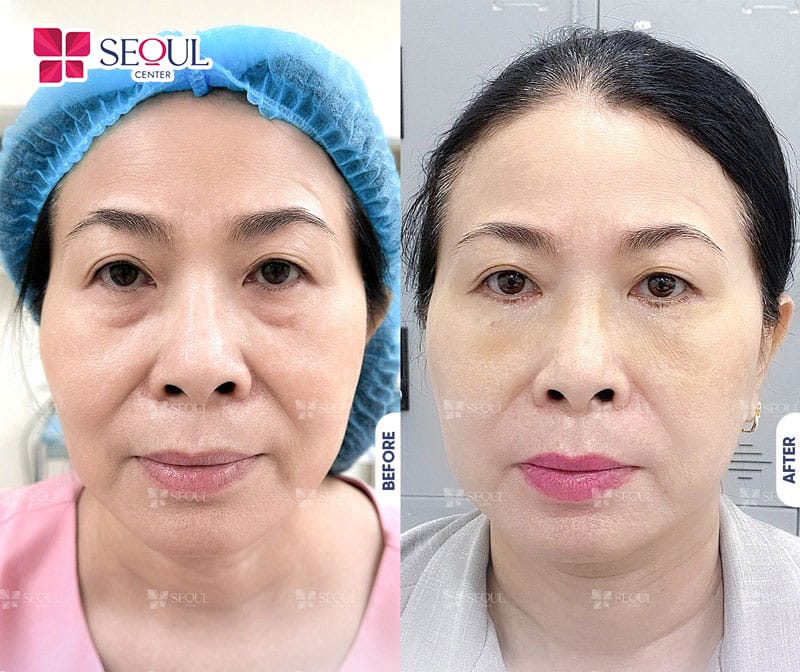 Làm thế nào để chọn nơi tiêm có tiêu chuẩn an toàn và kết quả tự nhiên?