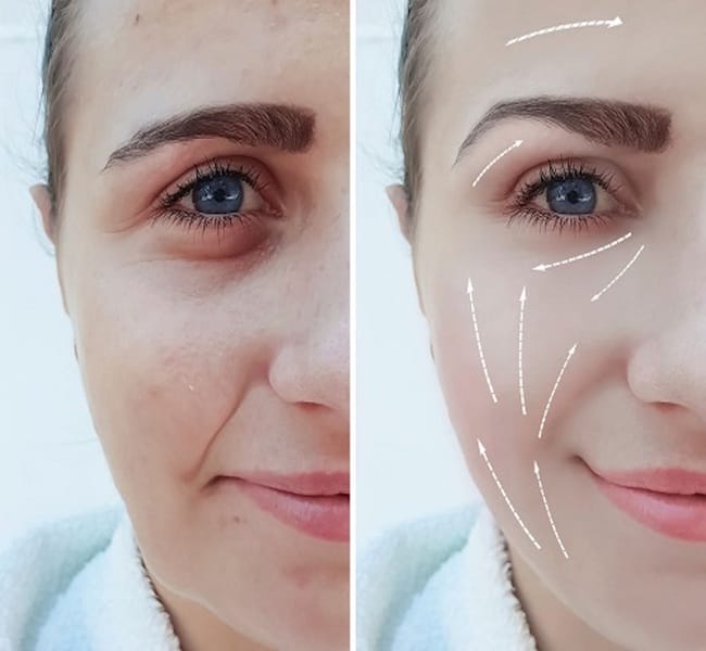Nếu gặp biến chứng ngay sau tiêm — xử trí tắc mạch máu và vai trò của hyaluronidase