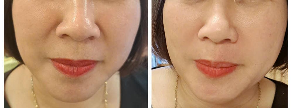 So sánh các phương pháp: tiêm filler so với phương án khác cho rãnh nhăn — nên chọn khi nào?