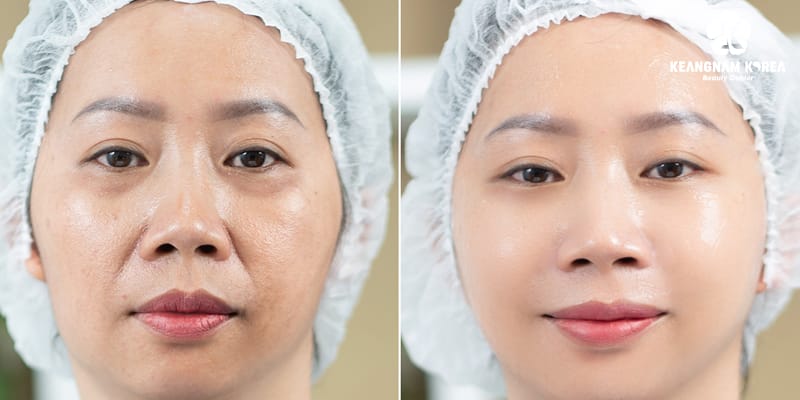 Lona Skin Lab khuyến nghị điều gì khi cân nhắc tiêm filler xóa rãnh nhăn?