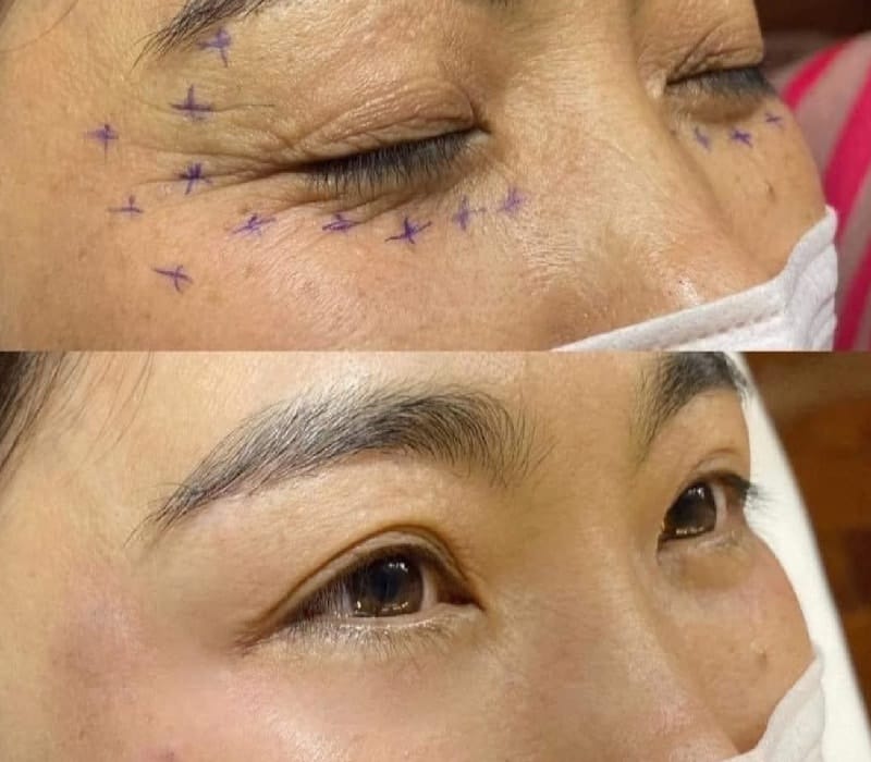 Cơ chế tác động của filler vùng đuôi mắt và loại filler nào phù hợp?