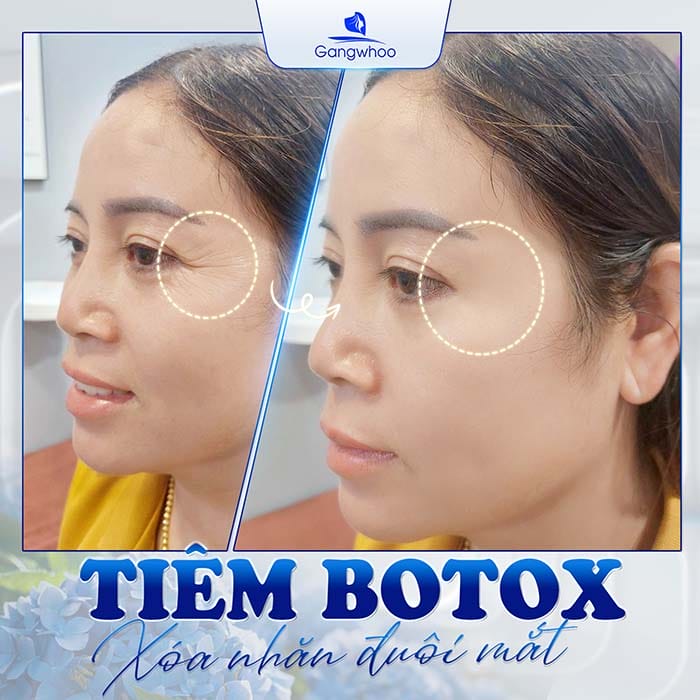 Quy trình một buổi tiêm filler đuôi mắt an toàn — gồm những bước nào?