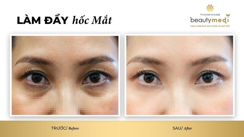 So sánh: Tiêm filler đầy hốc mắt so với phẫu thuật và liệu pháp khác — nên chọn gì?