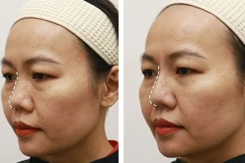 Các loại filler làm đầy khác biệt (tóm tắt)