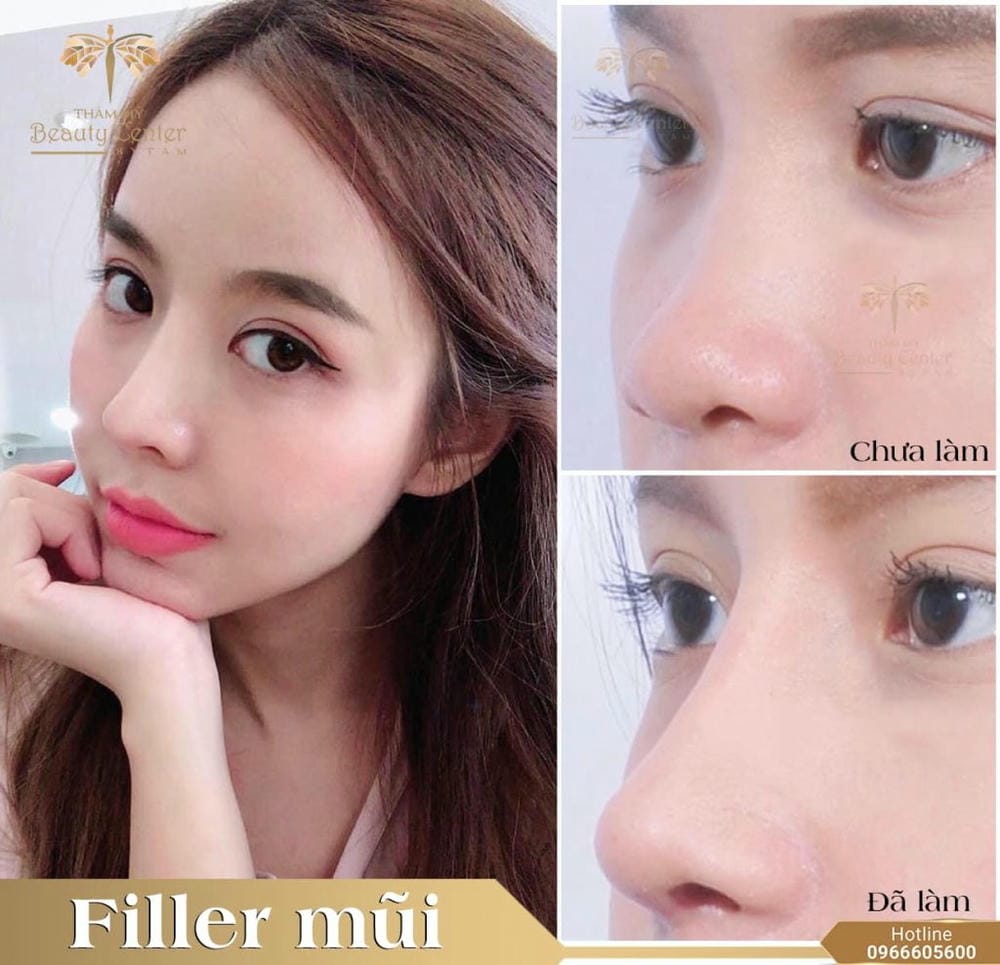 Làm sao để chọn nơi tiêm filler mũi an toàn — tiêu chí và filler HA chính hãng?