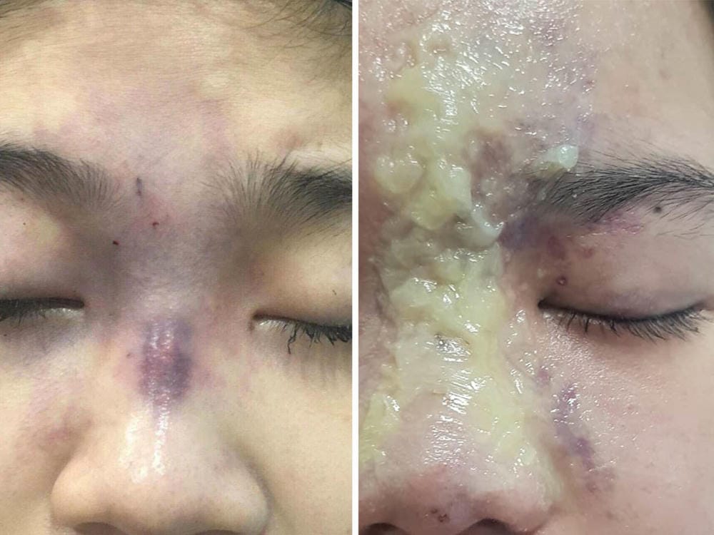 Tiêm filler đầy mũi có an toàn không và hiệu quả giữ được bao lâu?
