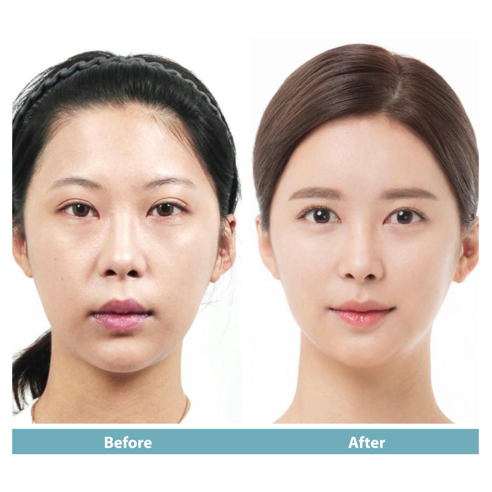Tiêm theo MD Codes hay chỉ tiêm chỗ rãnh cười — cách nào an toàn hơn?