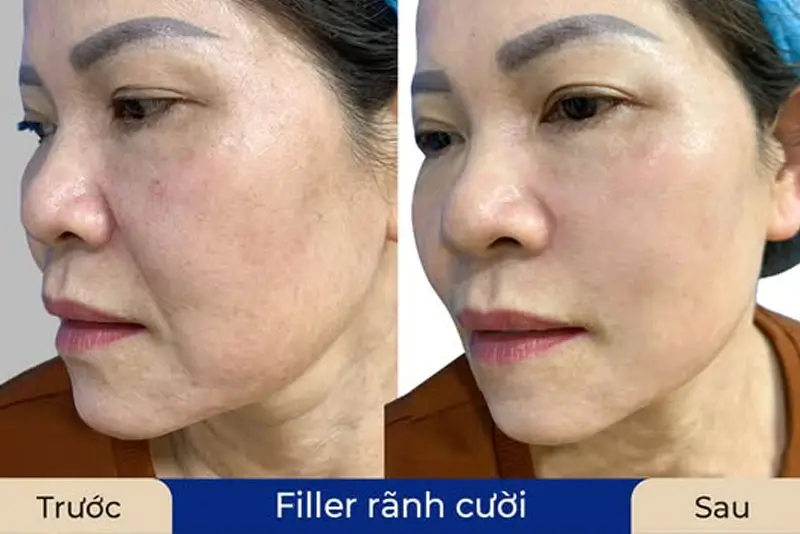 Chăm sóc sau tiêm và thời gian thấy hiệu quả