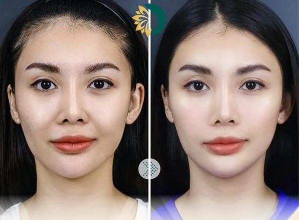 So sánh phương pháp: tiêm filler so với cấy mỡ tự thân hoặc nâng chỉ — phương pháp nào phù hợp?