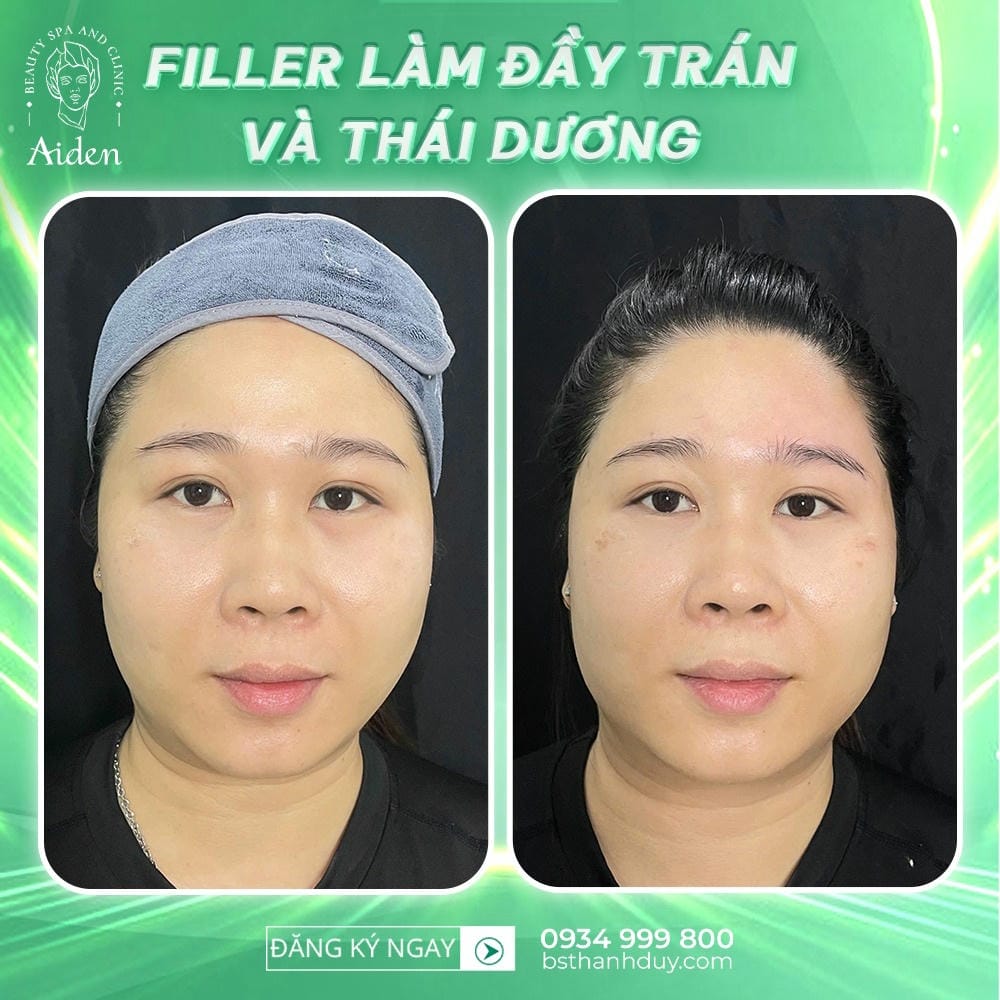 Điểm cần biết về tính chất filler (rheology) và lựa chọn theo vùng trán