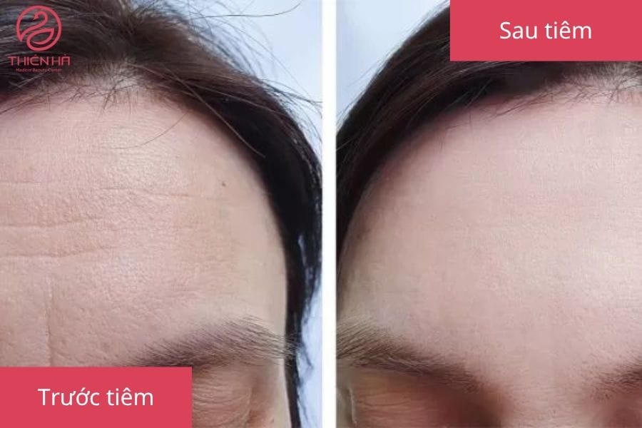 Chăm sóc sau tiêm: những điều dễ quên nhưng quan trọng