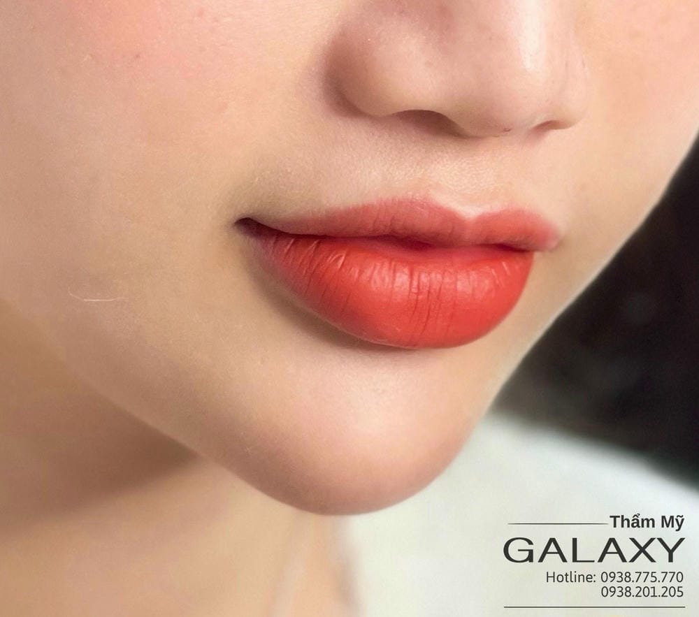 Ai phù hợp hoặc không phù hợp để tiêm filler — những chống chỉ định thường gặp?