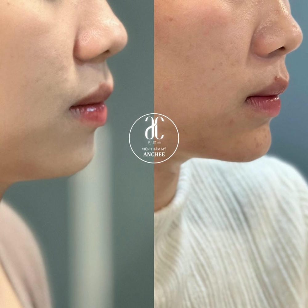 Loại filler nào phù hợp để độn cằm — filler HA hay CaHA (Radiesse), hiệu quả bao lâu?