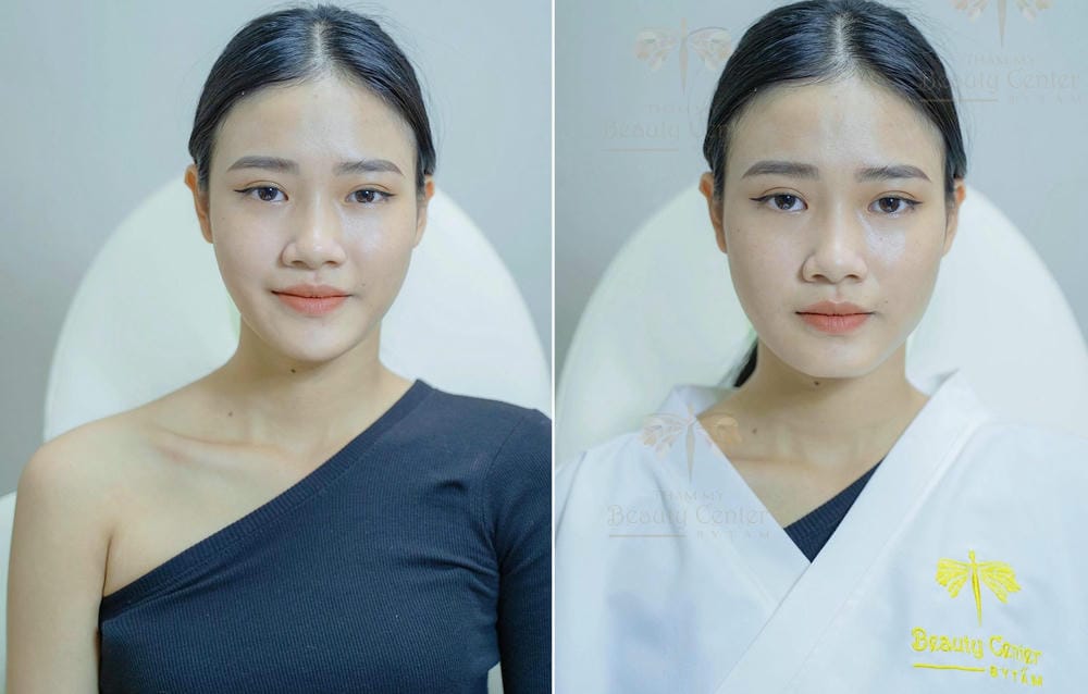 Tại sao có người đẹp tự nhiên còn có người thấy cằm cứng bí — filler hoạt động ra sao và có mấy loại?