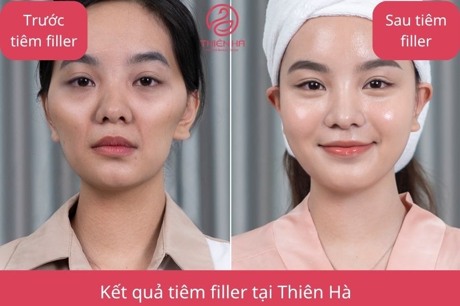 Làm sao chọn sản phẩm filler và hãng nào nên ưu tiên?