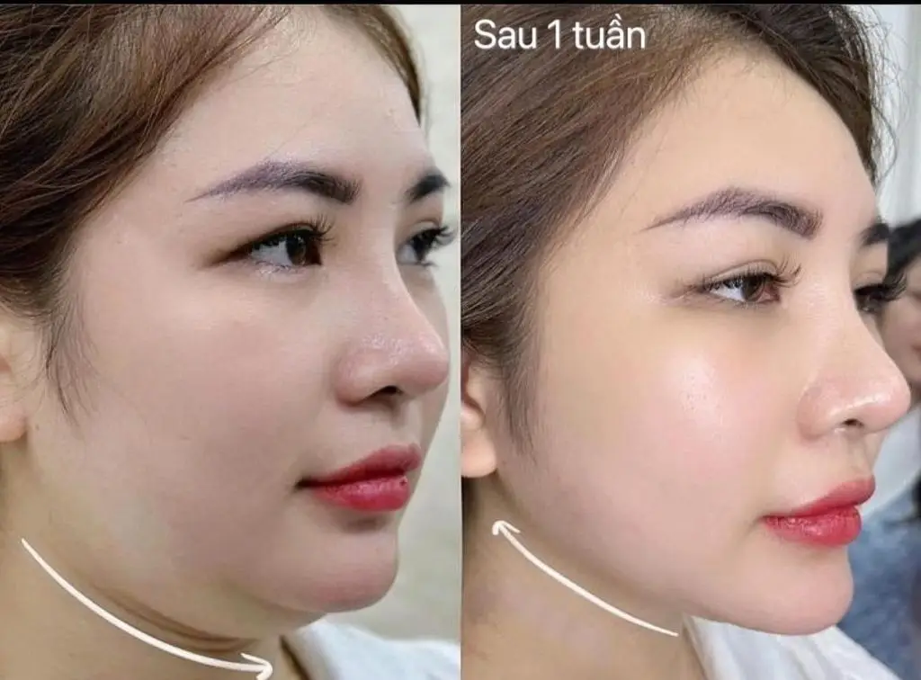 Tiêm filler cằm (HA – Hyaluronic Acid)