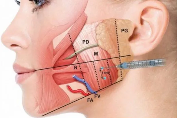 So sánh: Tiêm botulinum vs phương pháp khác để gọn quai hàm (phẫu thuật, filler, giảm mỡ)