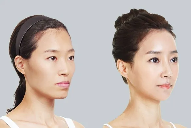 Tiêm botox so với tiêm filler má và phẫu thuật giảm xương gò má — chọn phương pháp nào?