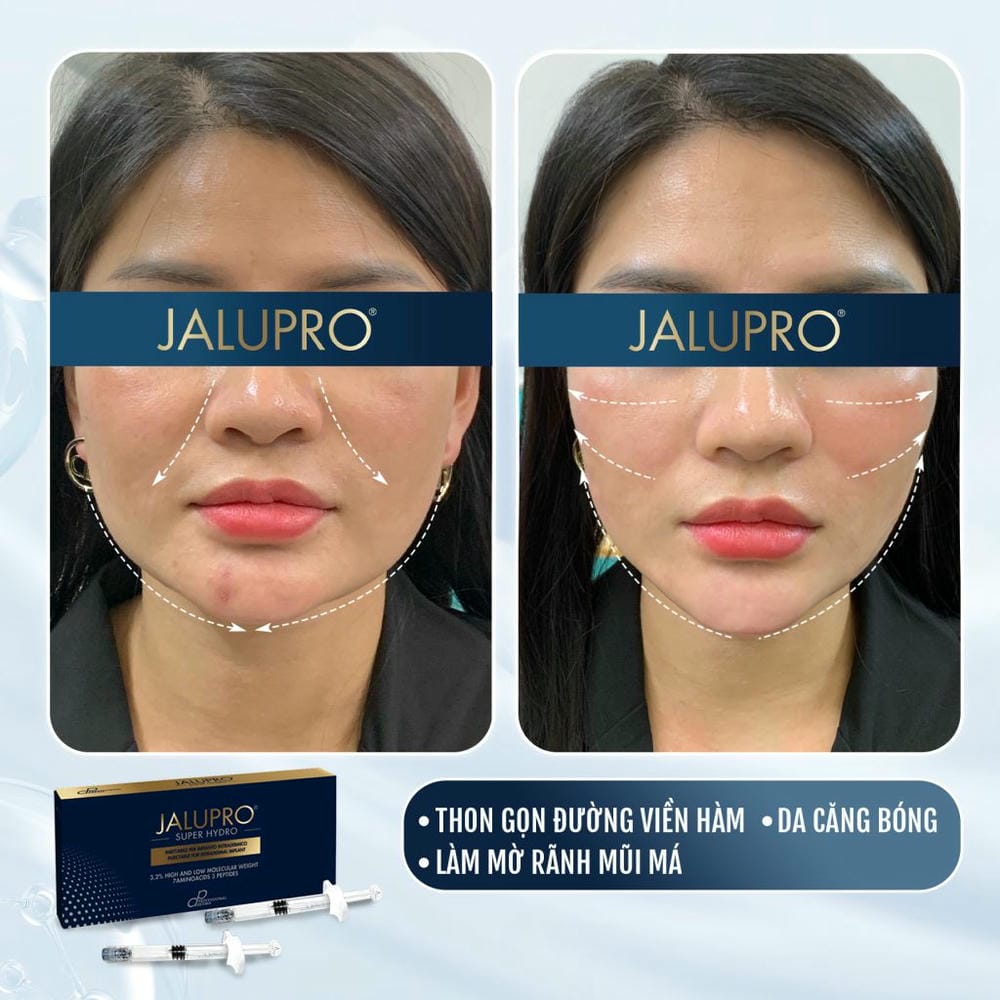 Chi phí tiêm Jalupro — các yếu tố ảnh hưởng và mức giá tham khảo