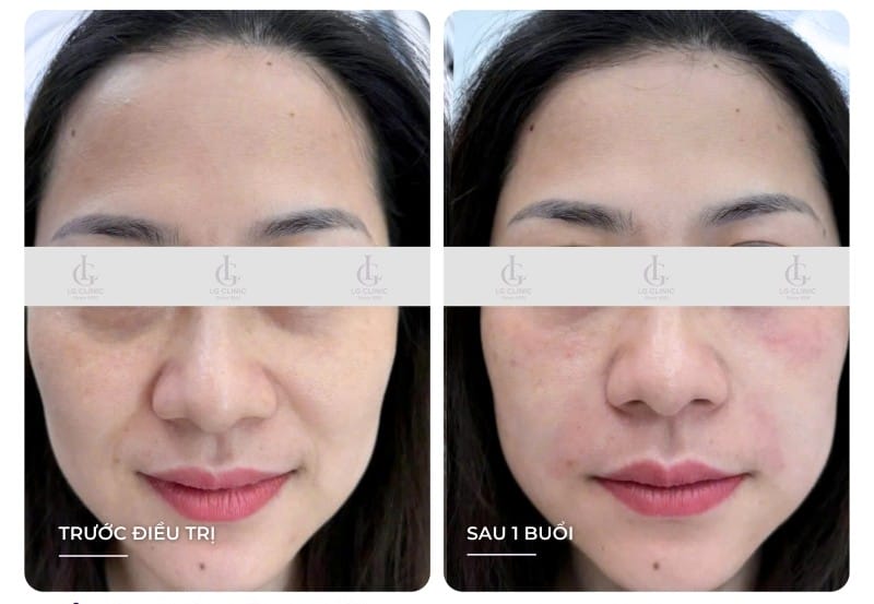 Tiêm Jalupro có tác dụng chính là gì và hoạt động ra sao?
