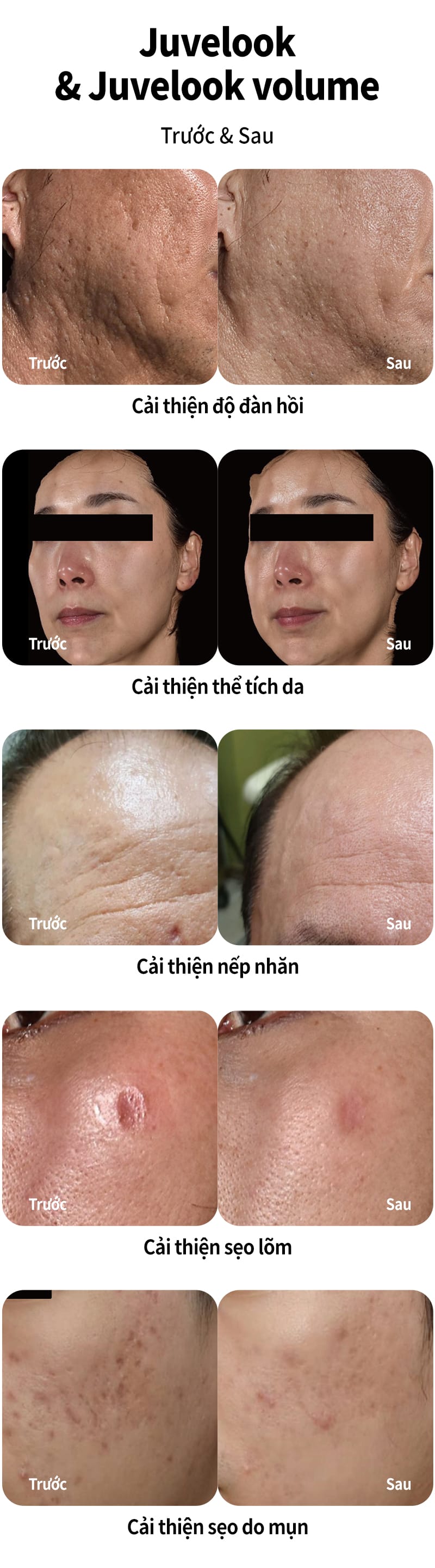 Quy trình tiêm Juvelook diễn ra như thế nào — cần chuẩn bị và chăm sóc ra sao?