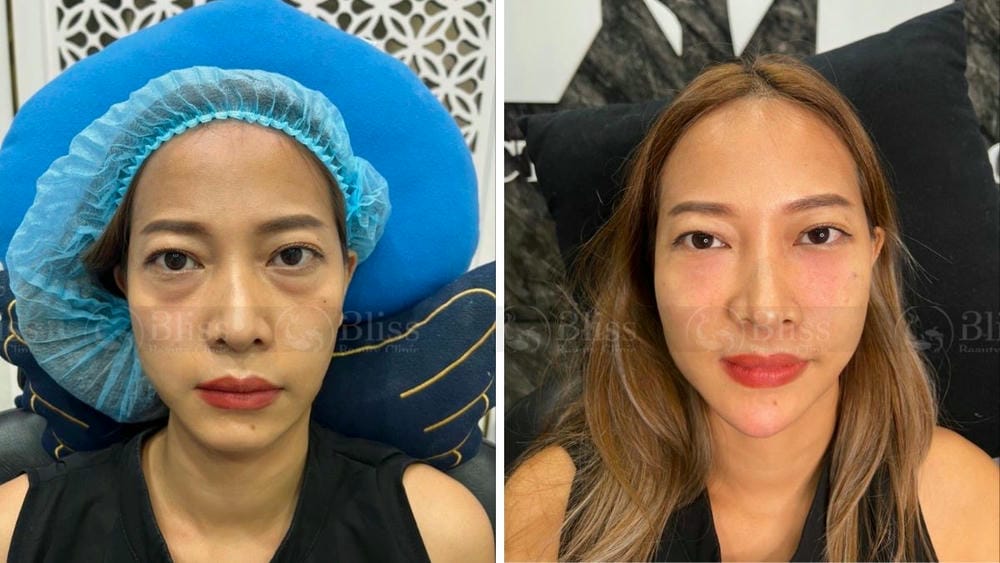 Bao nhiêu tiền và thời gian duy trì kết quả?