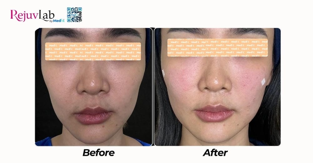 Tiêm Lenisna có rủi ro gì đặc biệt — biến chứng thường gặp và cách xử trí?