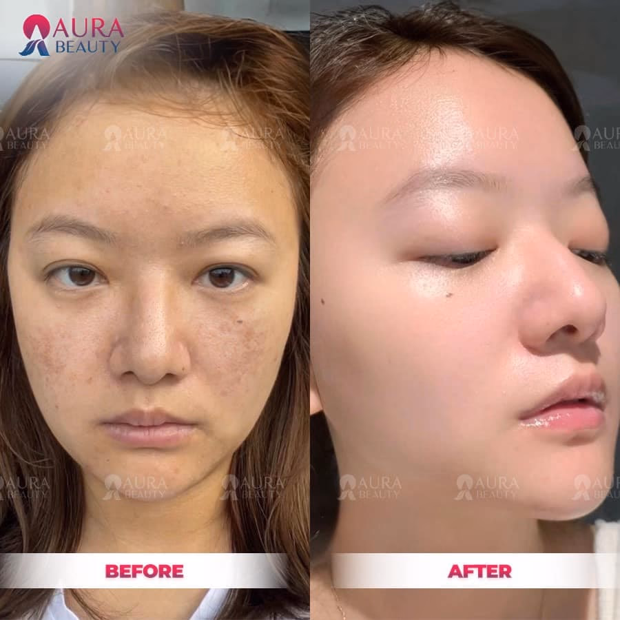 Tiêm meso cần làm bao nhiêu lần và khoảng cách giữa các buổi là bao nhiêu? — liệu trình meso
