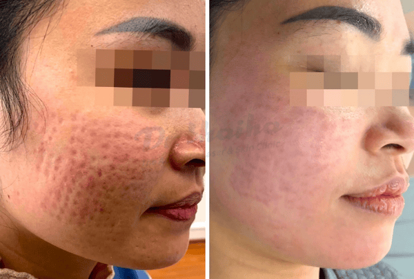 Chăm sóc sau tiêm meso: những việc cần làm và cần tránh