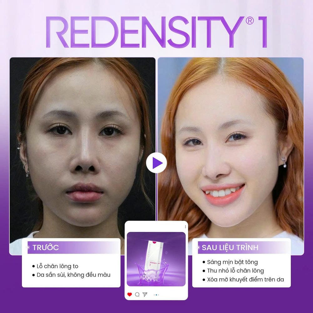 Nên hỏi bác sĩ gì trước khi tiêm meso?