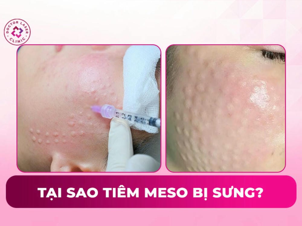 Sưng sau tiêm meso kéo dài bao lâu — thời gian hồi phục và khi nào cần lo?