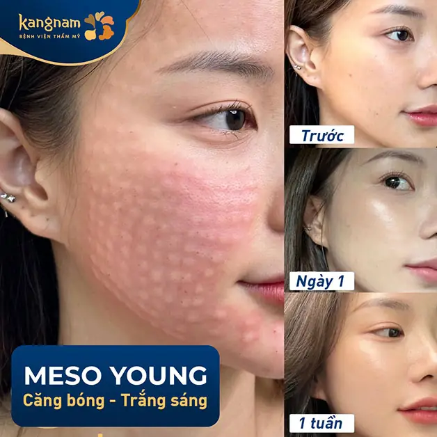 Làm sao để giảm đau trước, trong và sau khi tiêm meso?
