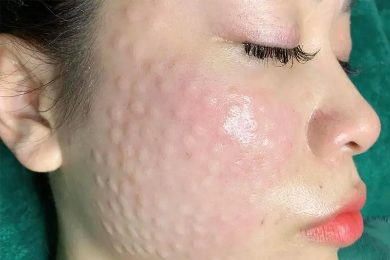 Tiêm meso bao lâu thì thấy kết quả? Thời gian thấy hiệu quả meso