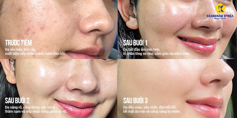 Làm sao để tối ưu hóa hiệu quả và kéo dài kết quả meso?