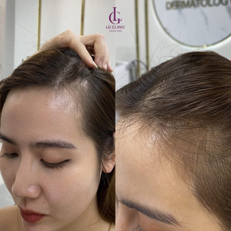 Mesotherapy so với PRP, microneedling, và minoxidil — nên chọn phương pháp nào?